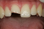 Jak se zachovat při úrazech zubů?