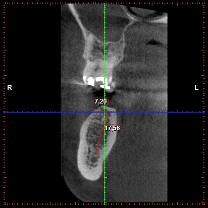 CT snímek nabídky kosti do chybějící dolní šestce
